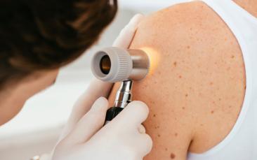 Melanoma insights could hold benefit for all cancers
